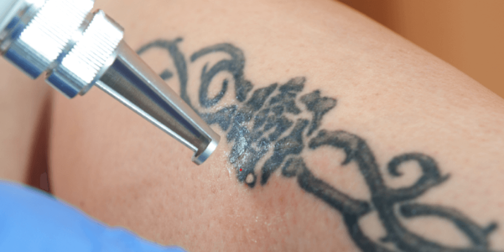 7-other-ways-to-remove-a-tattoo